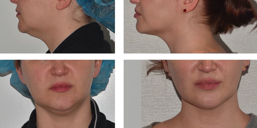 Before and after