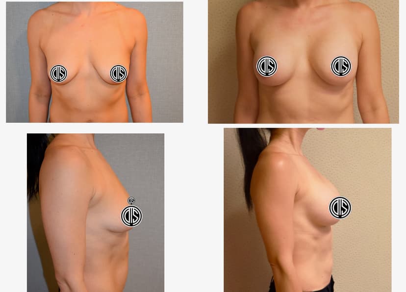Before and after