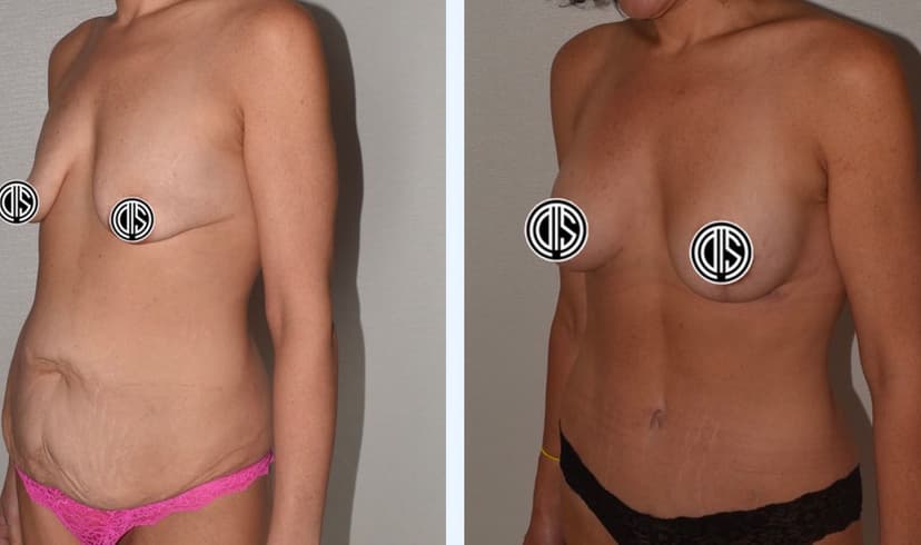 Before and after