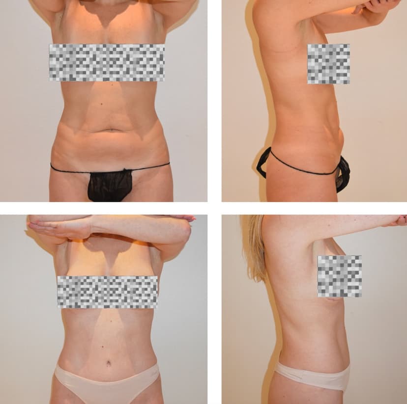 Before and after