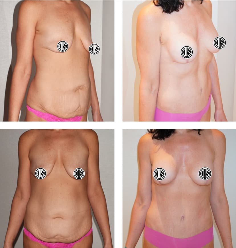 Before and after