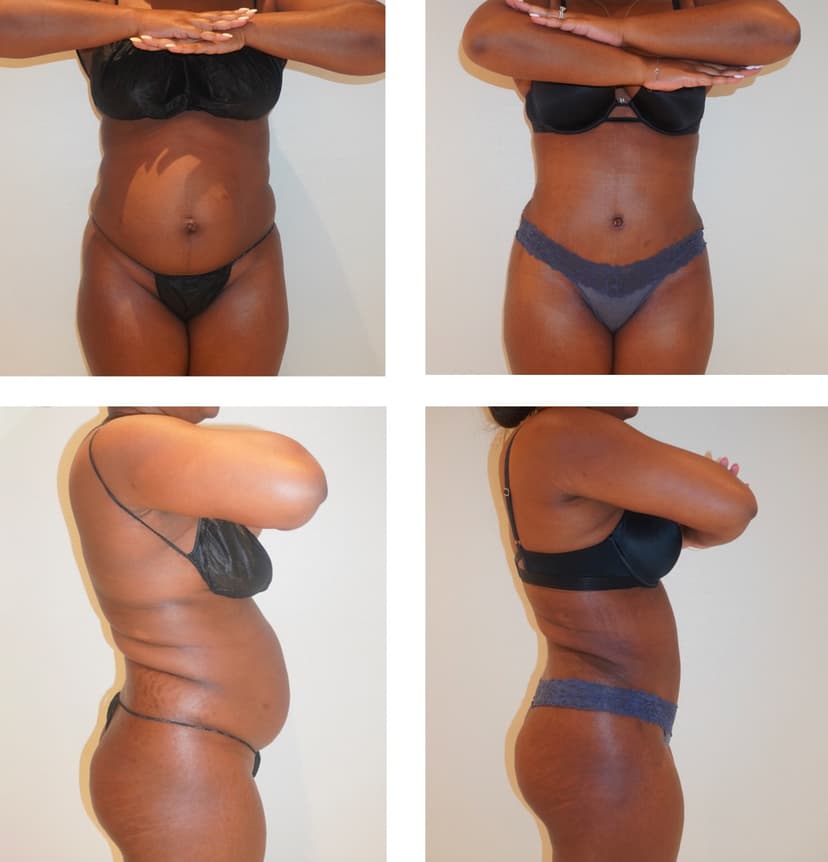 Before and after