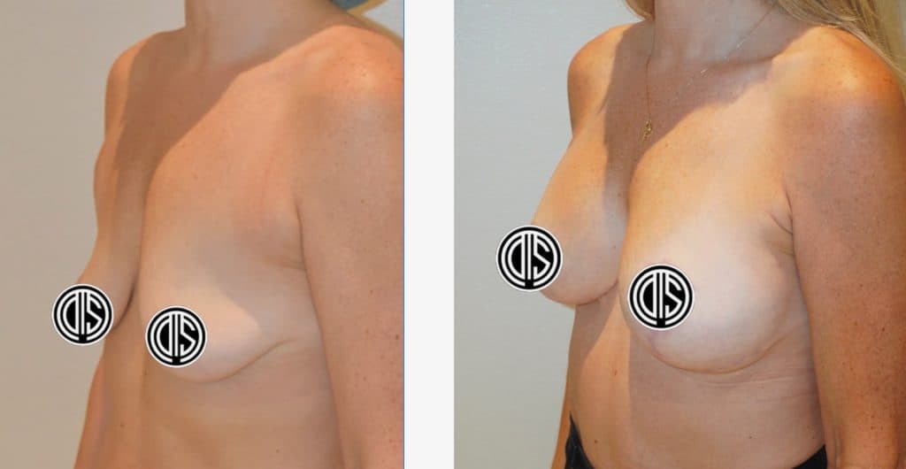 Breast Lift before and after