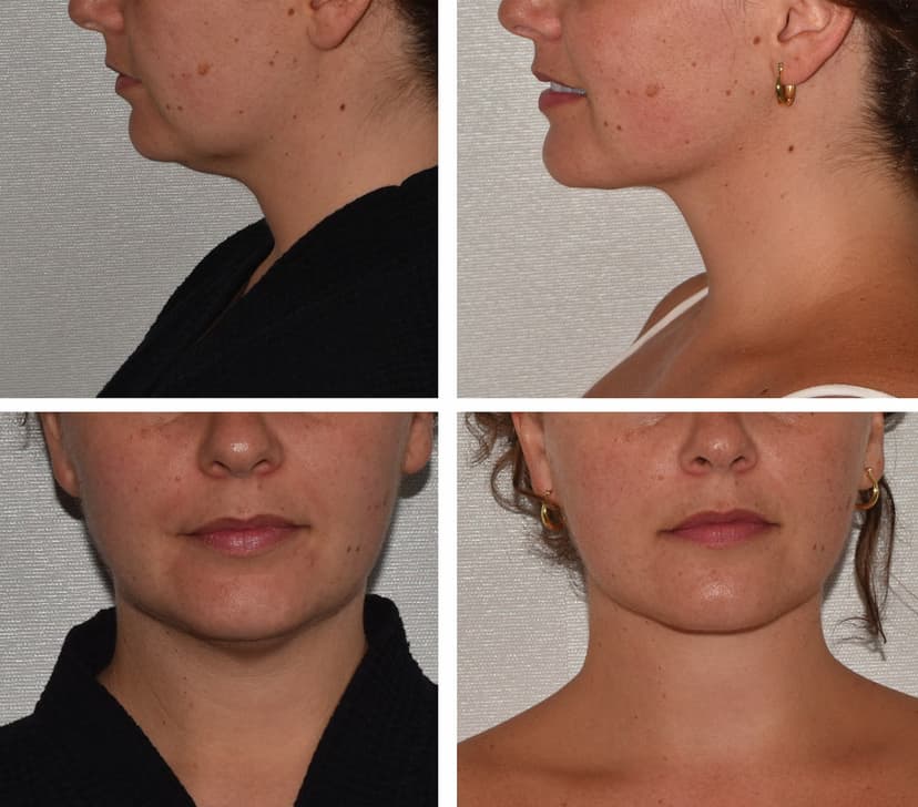 Before and after