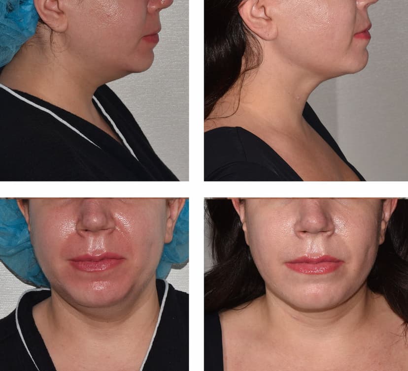 Before and after