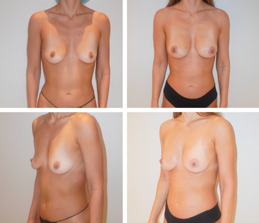 Before and after