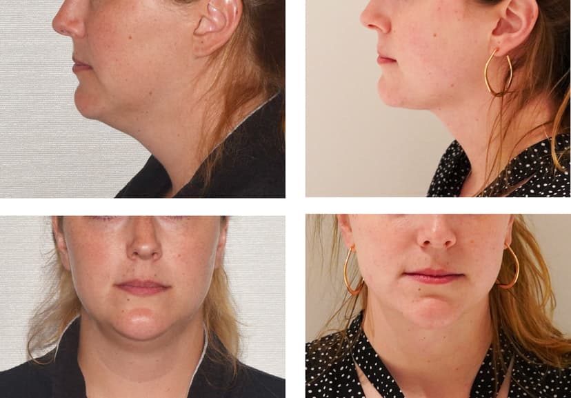 Before and after