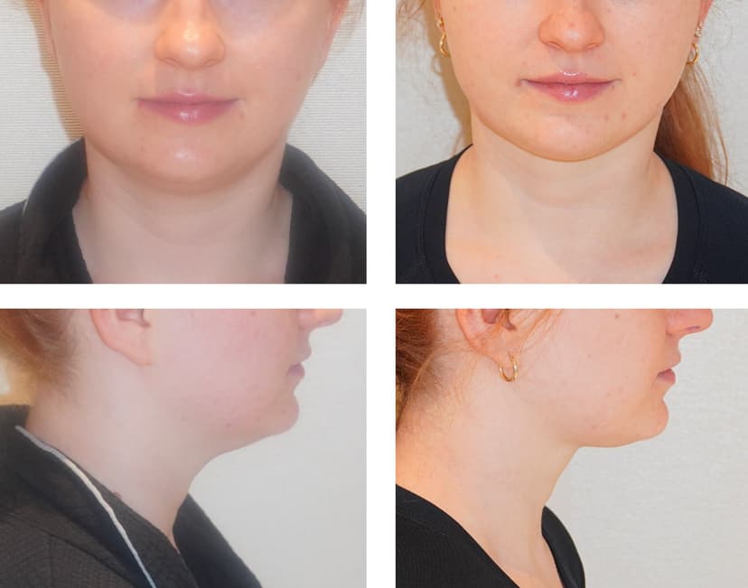 Before and after