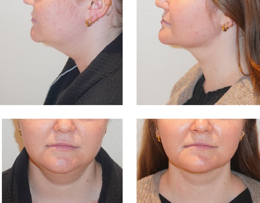 Before and after