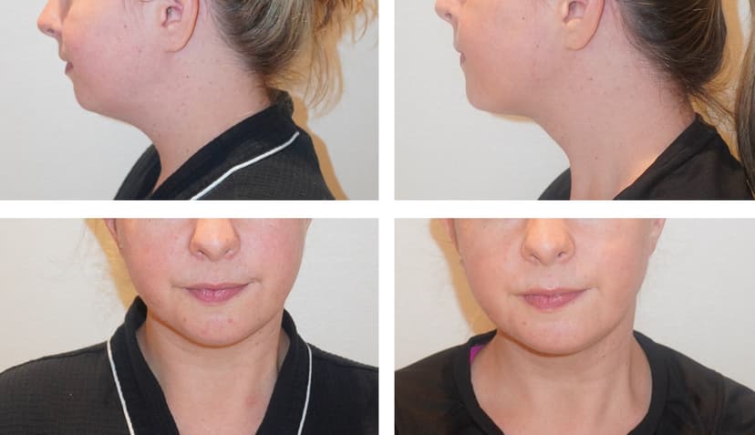 Before and after