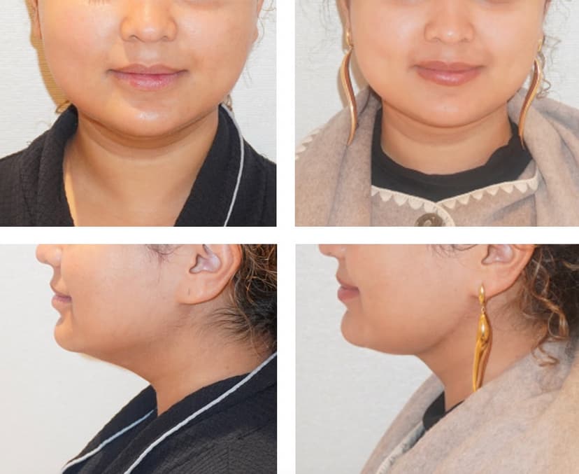 Before and after