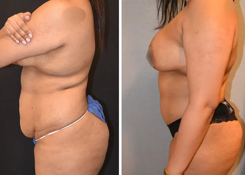 Abdominoplasty Before and After Photos - 3