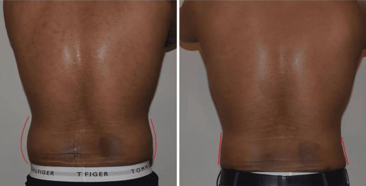 Male Liposuction Before and After Photos - 5