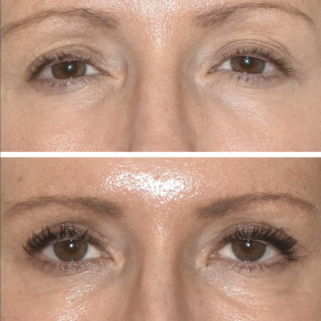 Blepharoplasty Before and After Photos - 3