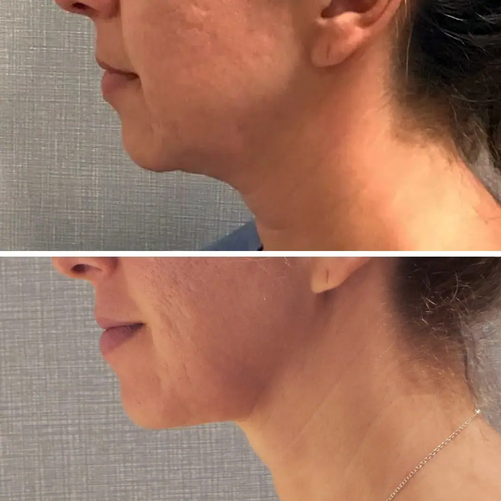 Bodytite Before and After Photos - 6