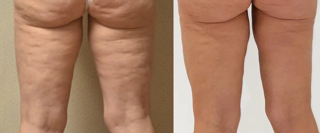 Bodytite Before and After Photos - 8