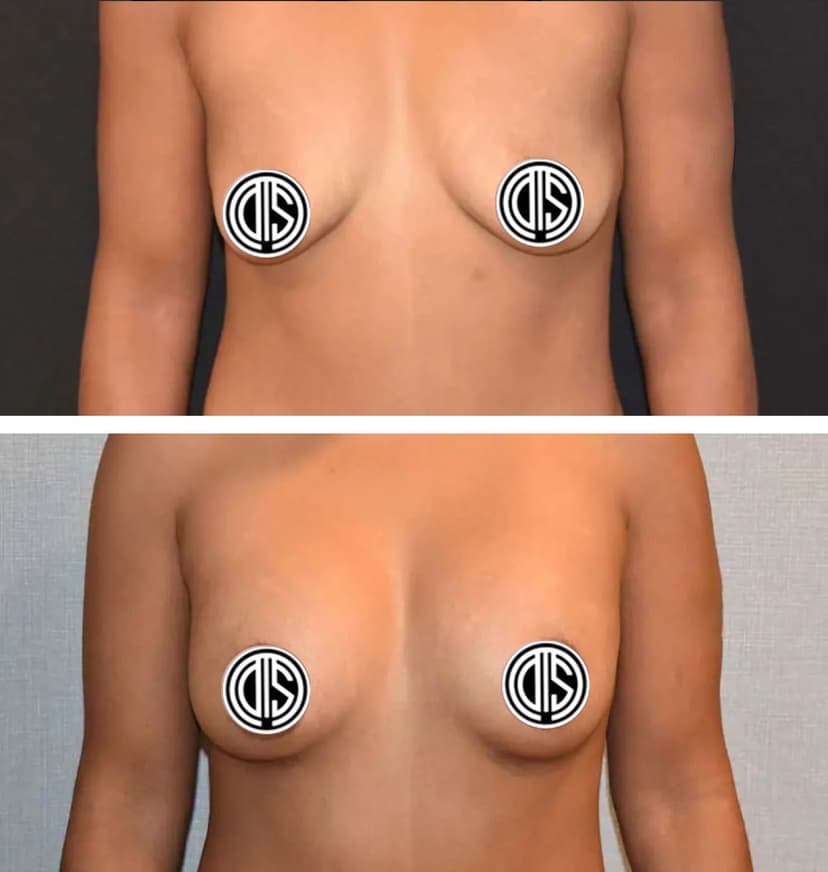 Before and after