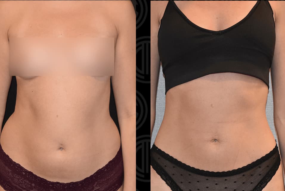 Liposuction before and after