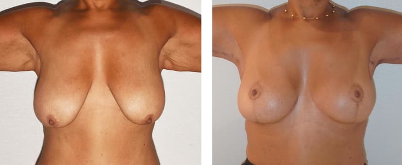 Before and after