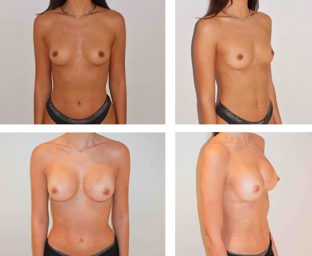Breast Augmentation before and after