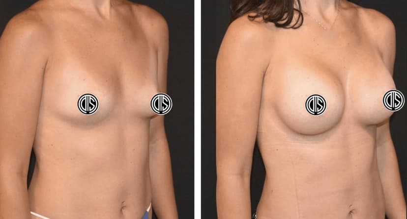Side-by-side comparison of a woman’s torso before and after breast augmentation surgery with Motiva Implants, highlighting the increased breast size in the after image.