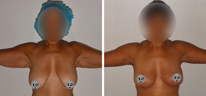 Side-by-side photos showing a person with arms raised before and after a Breast Lift procedure, with face and chest areas obscured for privacy.