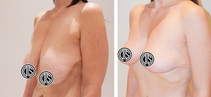 Side-by-side comparison of a woman’s torso before and after a Breast Lift, highlighting noticeable changes in breast shape and position.
