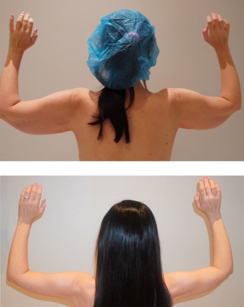 Two images show a woman from behind with arms raised; the top image displays looser skin, while the bottom highlights tighter, more toned arms after an Arm Lift (Brachioplasty).
