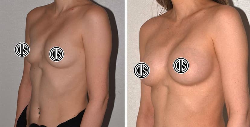 Side-by-side comparison of a person’s chest before and after breast augmentation surgery using Motiva Implants, with nipples censored for privacy.