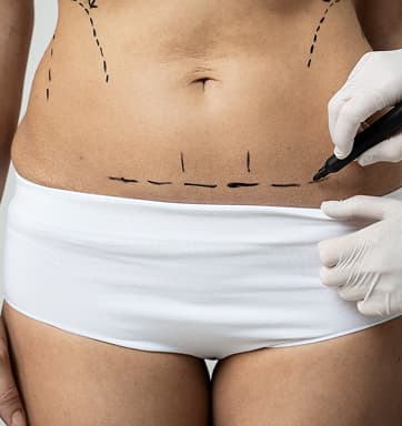 Liposuction