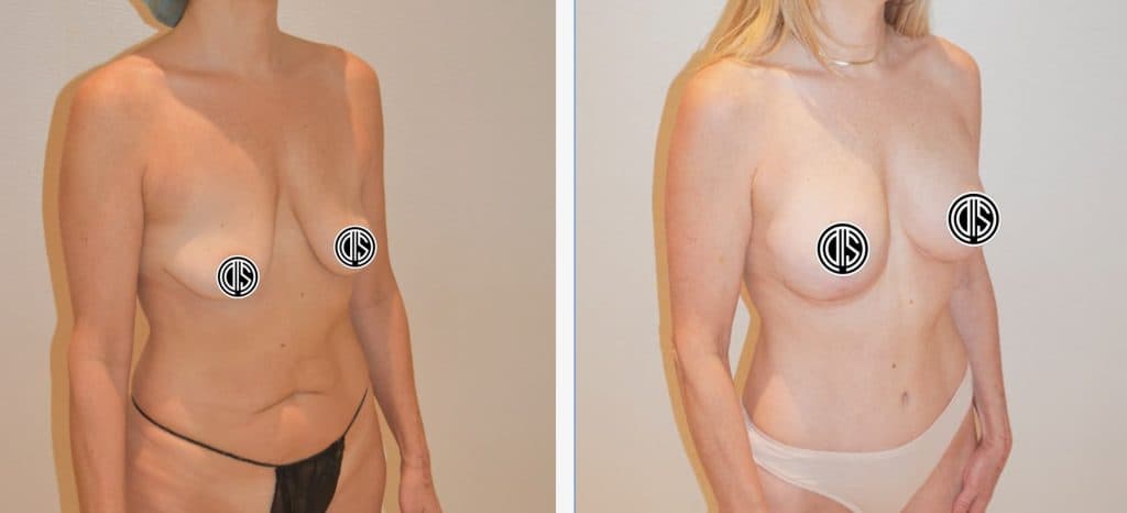 Mommy Makeover before and after