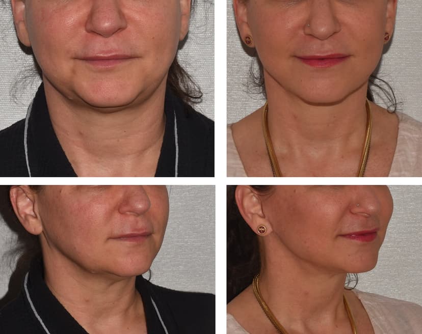 Before and after