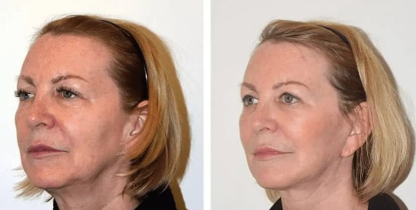 Before and after