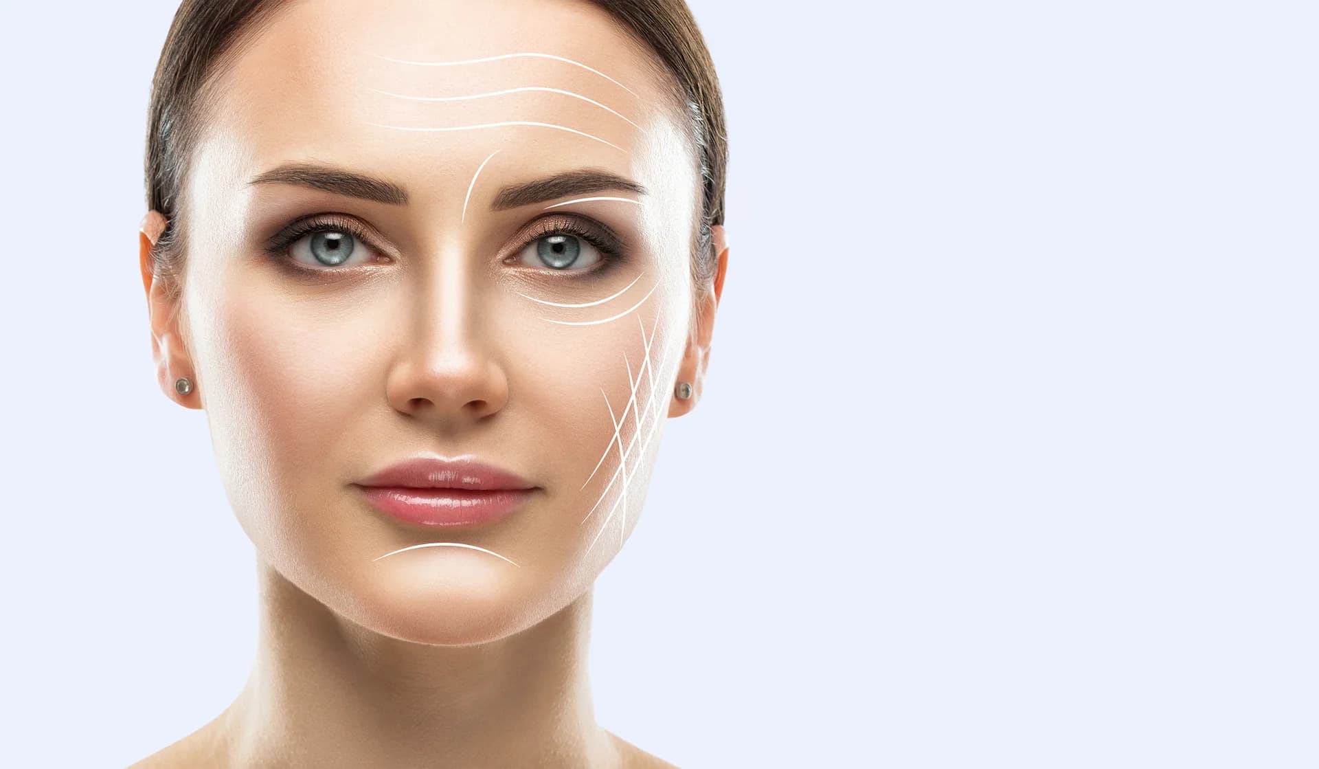 A woman's face with lines drawn on it, undergoing buccal fat removal procedure for facial contouring.