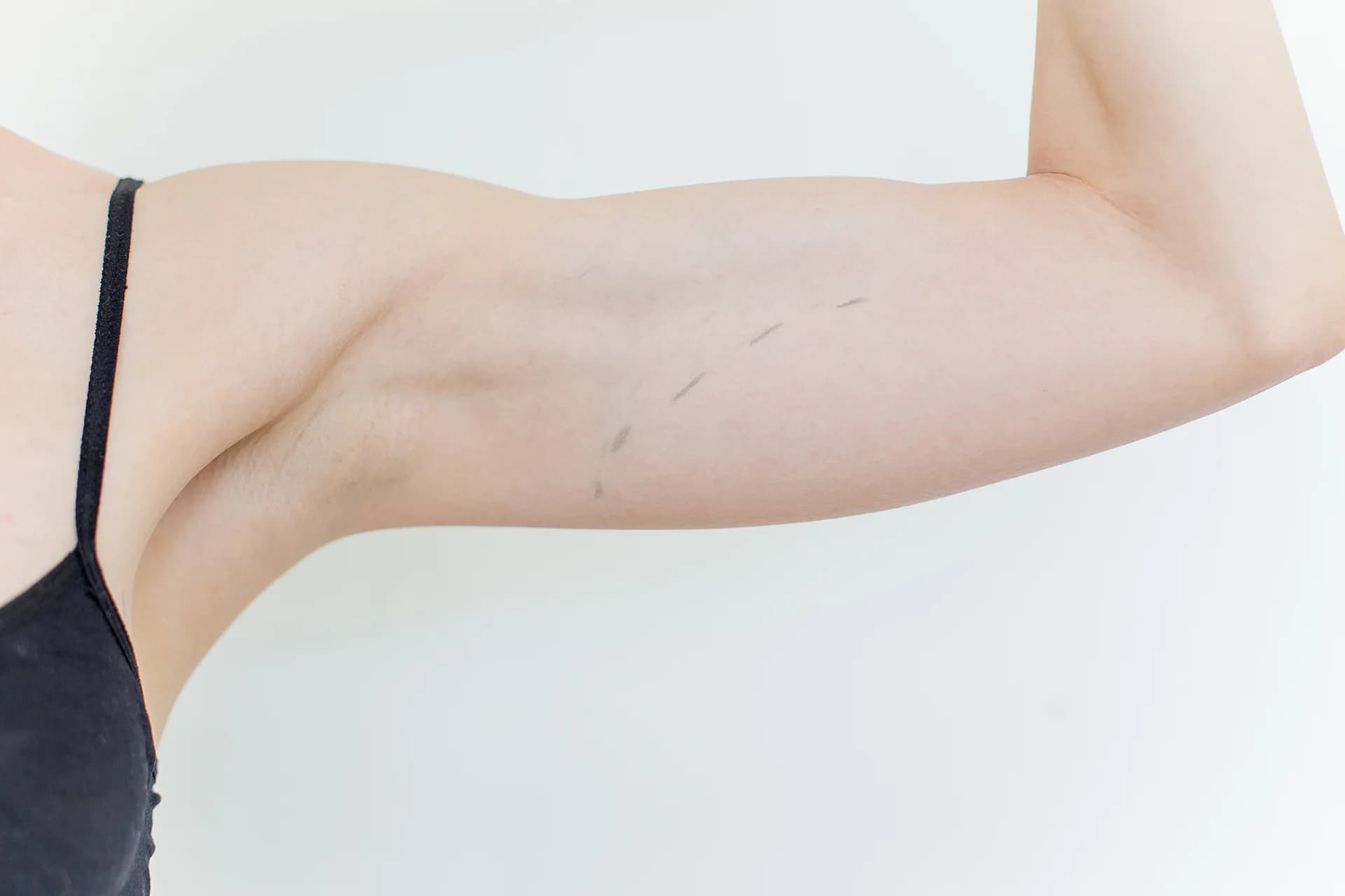 A woman's arm after lipo with j-plasma
