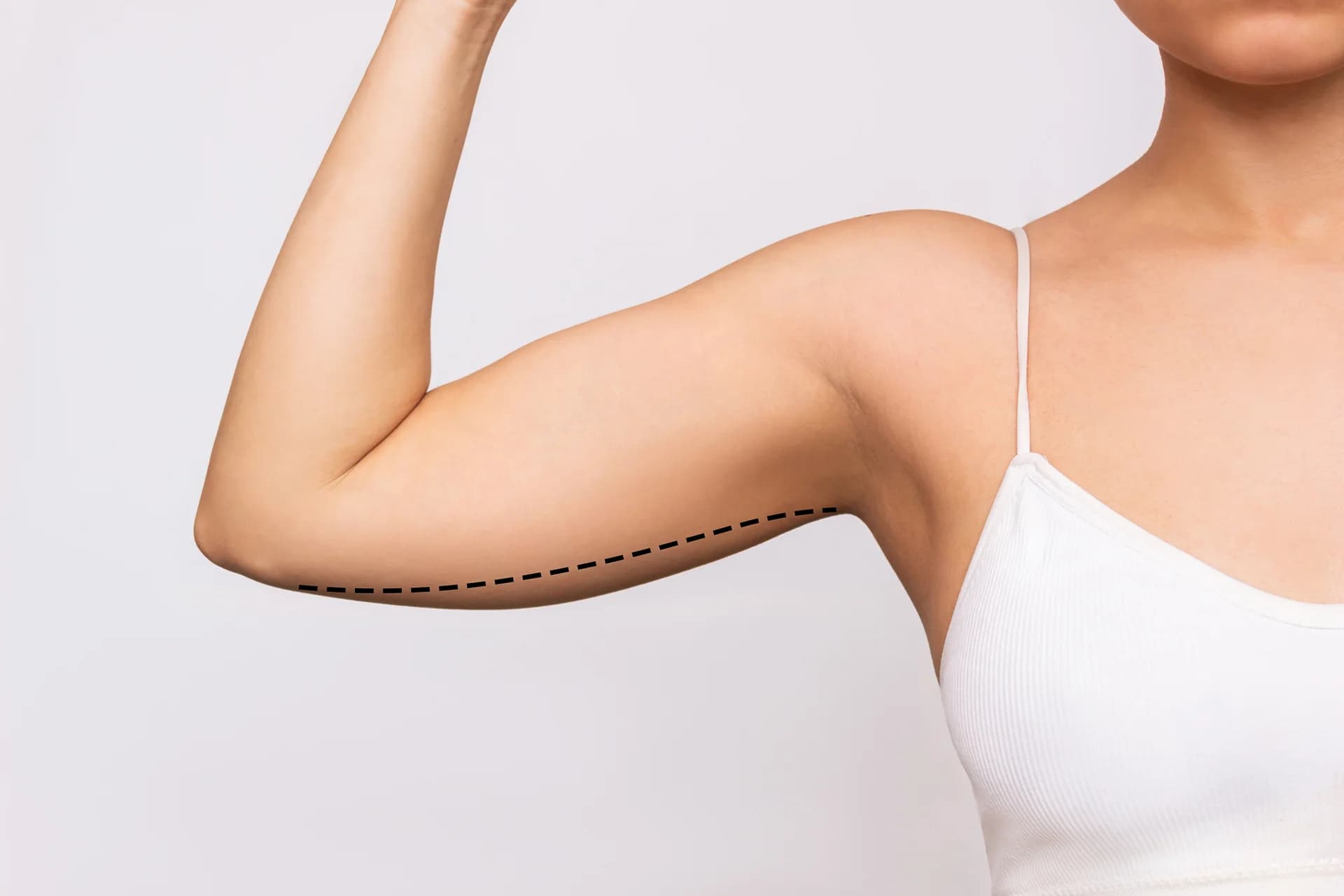 A woman flexing her arm after a brachioplasty procedure