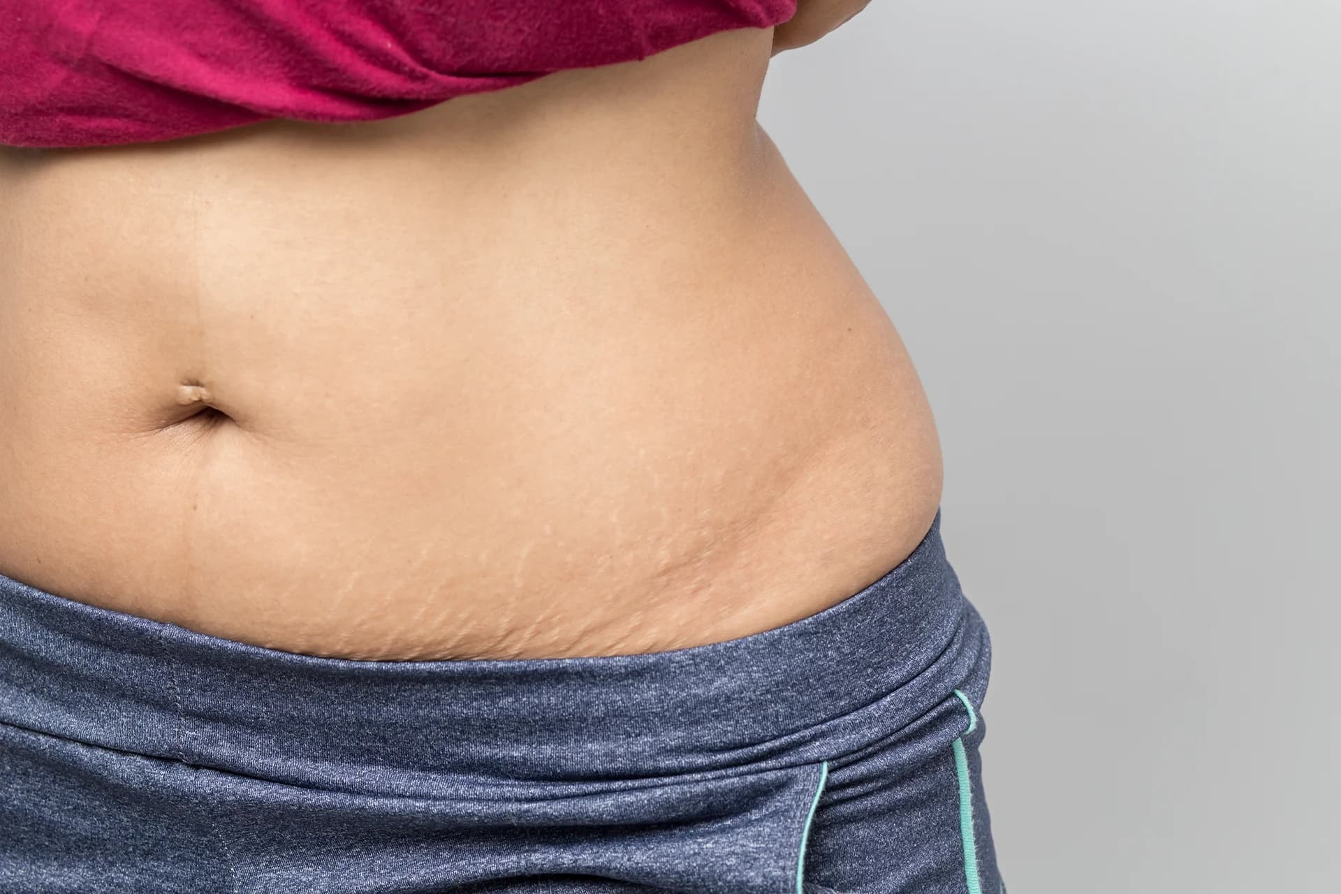 Close-up of a woman's midsection showing belly fat, wearing a magenta top and blue workout pants with a drawstring, ideal candidate for Mommy Makeovers.