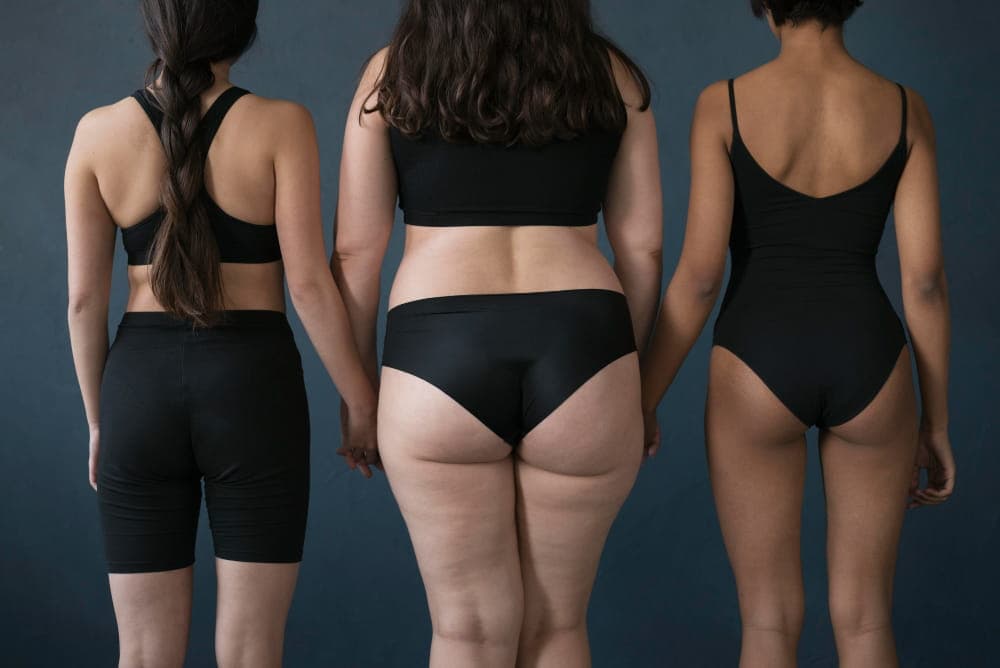 Three women standing side by side, facing away from the camera, wearing black underwear and sportswear against a dark background, highlighting lipedema differences compared to regular fat.