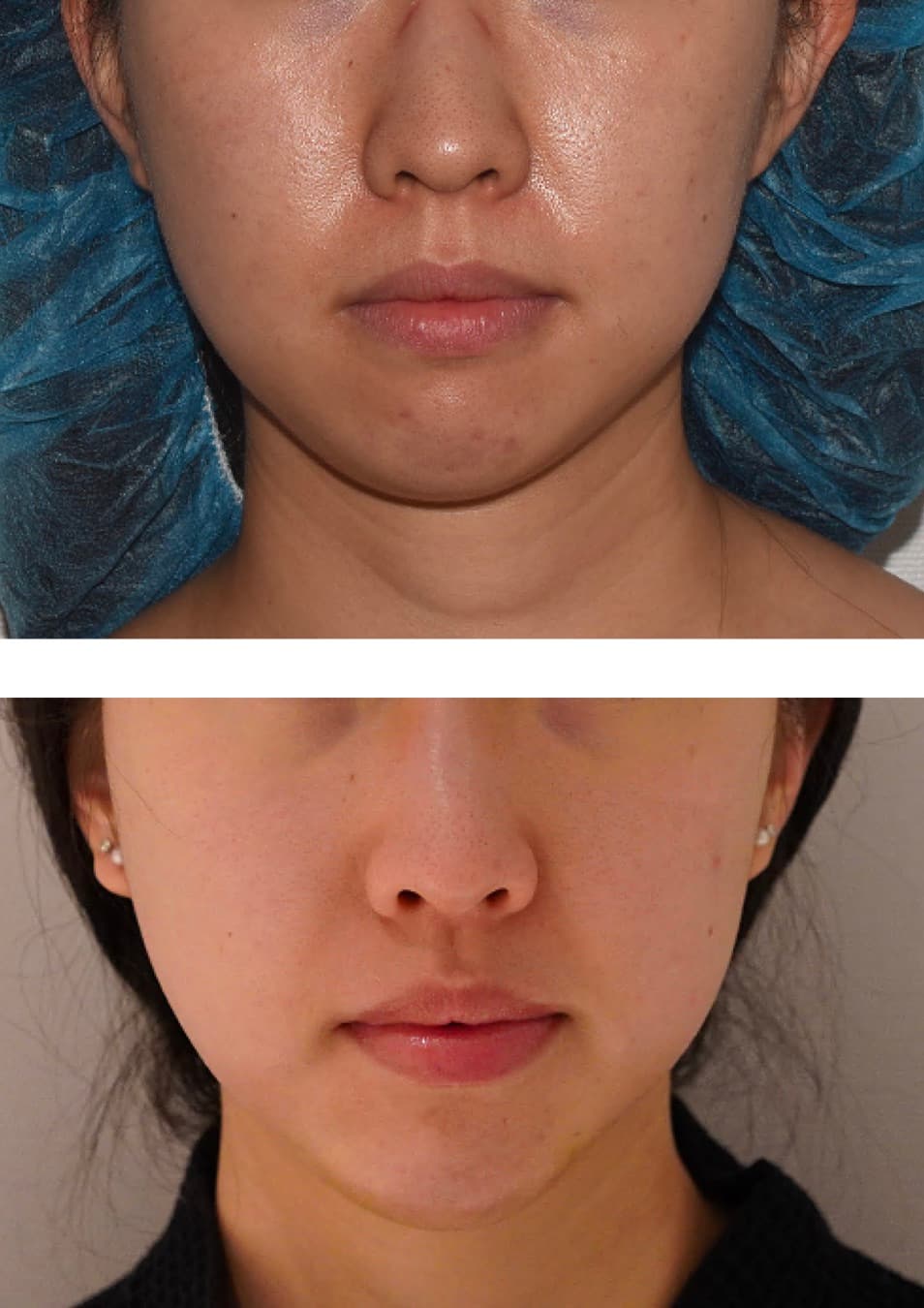 Two side-by-side photos show a woman's lower face before (top) and after (bottom) a Facial Fat Transfer, with reduced jaw width and smoother skin in the after image.