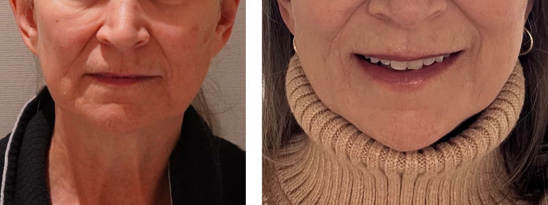 Side-by-side comparison of a woman's lower face before and after Facial Fat Transfer, showing reduced wrinkles and a smoother appearance in the second image.