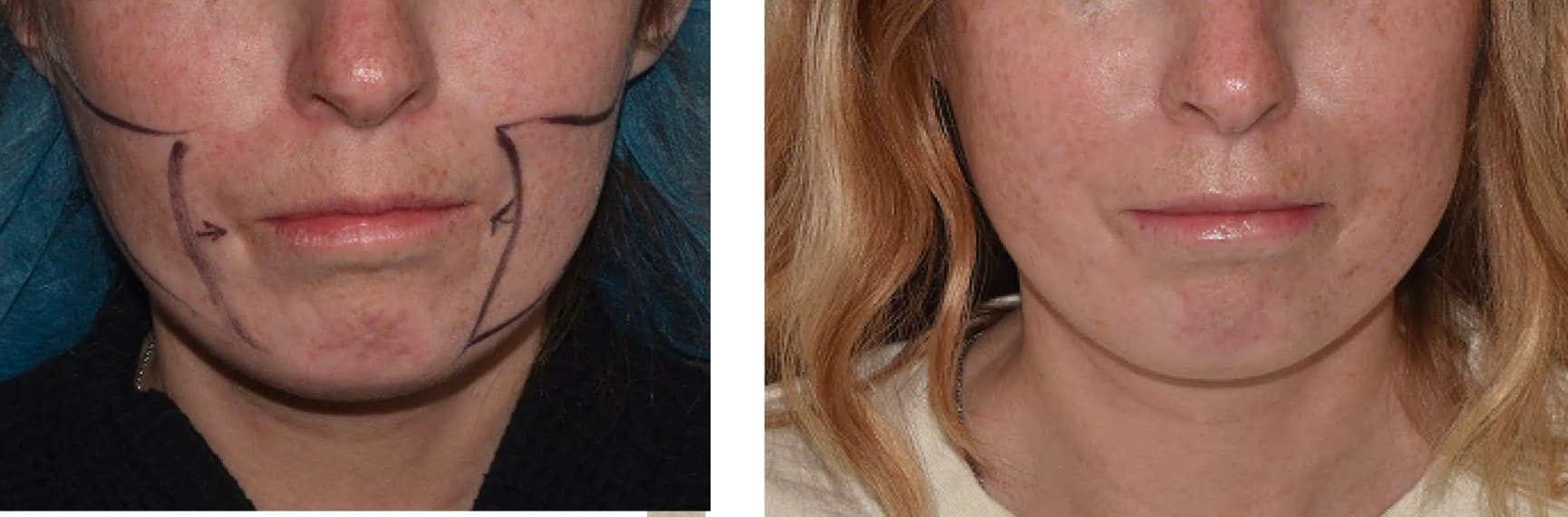 Side-by-side photos of a woman's lower face; the left image shows surgical markings for Facial Fat Transfer on her cheeks and jawline, while the right image shows her face without markings after treatment.