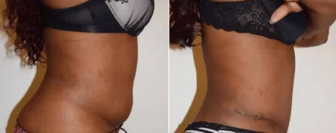 Abdominoplasty before and after photos showcasing tummy tuck transformation.