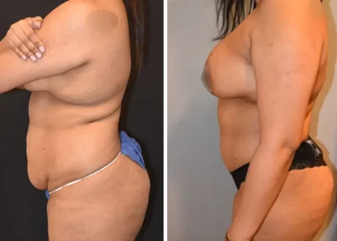 Abdominoplasty before and after photos showcasing the transformative results of a tummy tuck procedure.