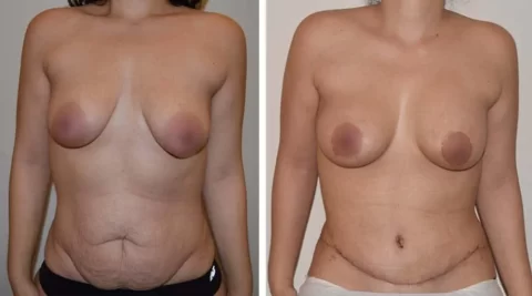 Abdominoplasty before and after photos of breast surgery.