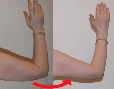 Arm Lift Before and After Photos of a woman's arm.