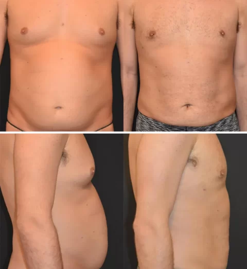 Male tummy tuck before and after.