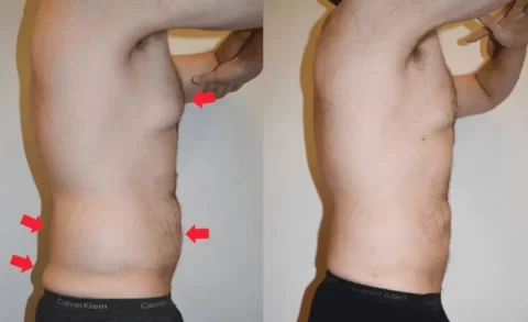 Male liposuction before and after photos showcasing a transformation of a man's tummy through a tummy tuck procedure.