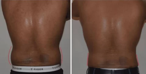 Male tummy tuck before and after photos.