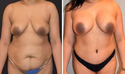 A woman's breasts before and after Mommy Makeover surgery.
