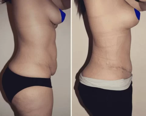 Mommy makeover before and after photos showcasing tummy tuck results.